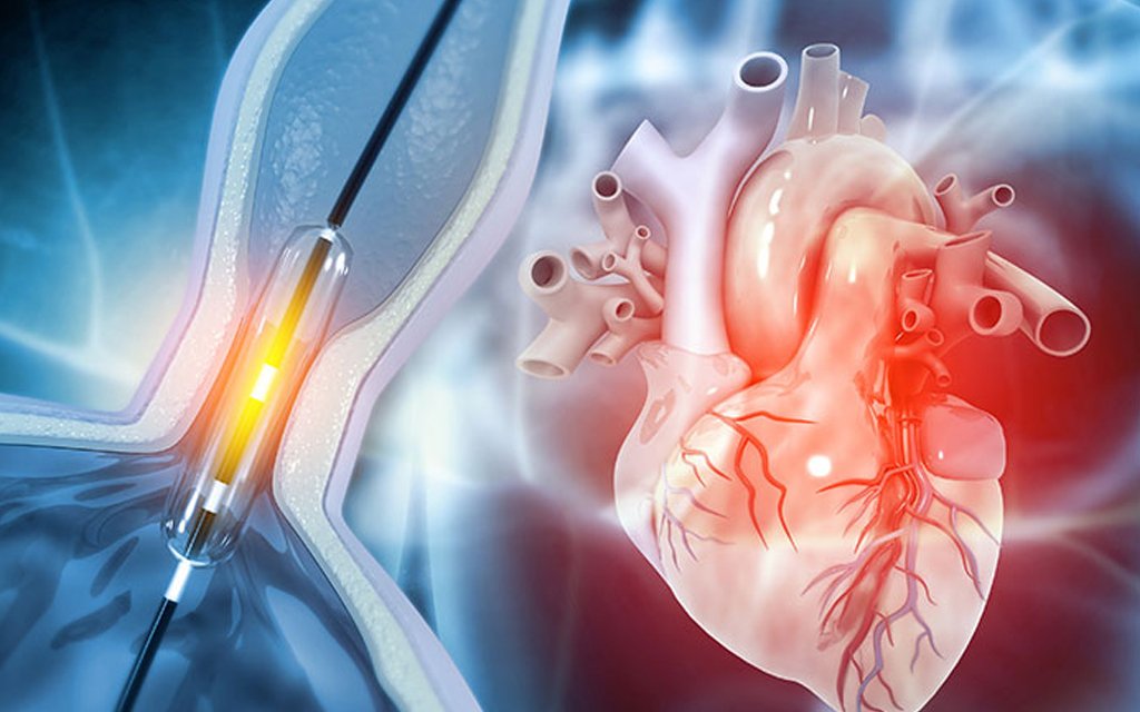 angioplasty stent placement