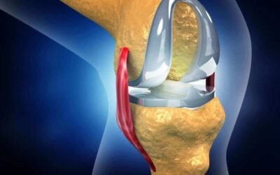 How Long It Take To Recover From Knee Replacement Surgery?