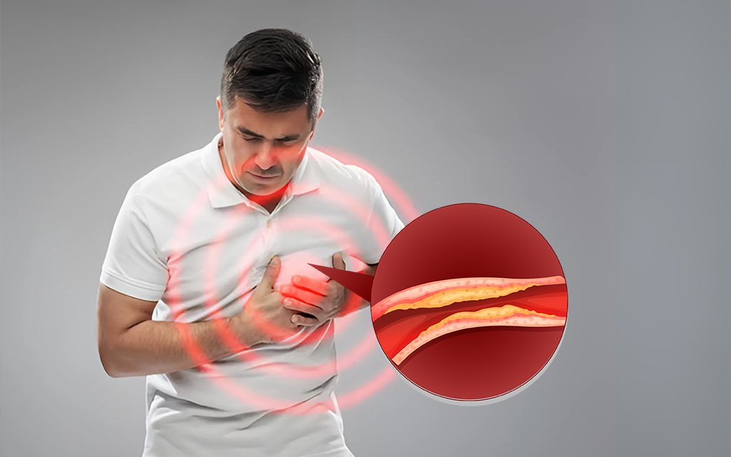 heart attack and blockage