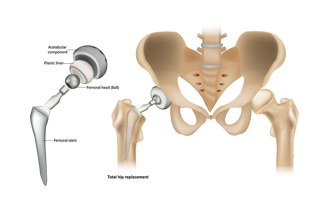 hip replacement procedure